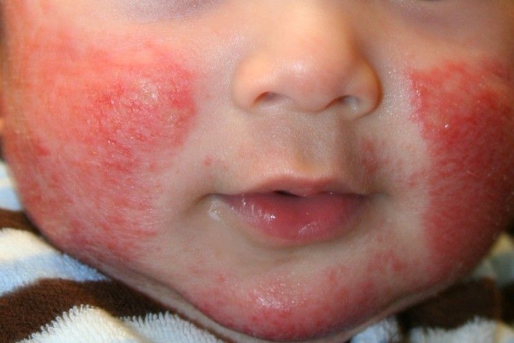 Себорейный дерматит у ребенка на голове